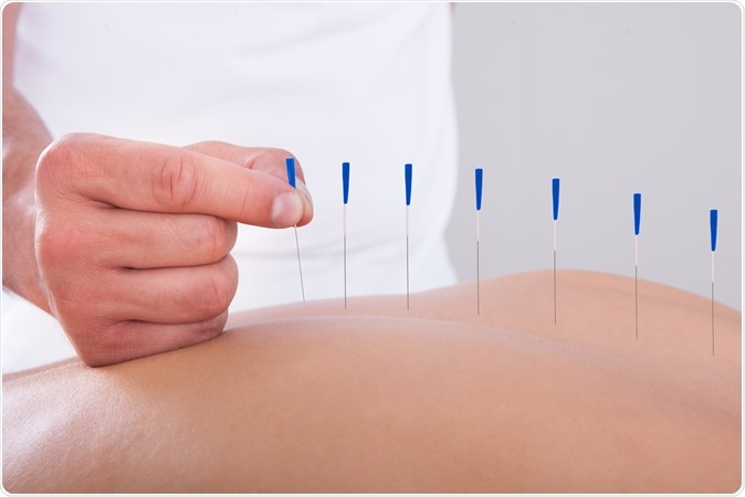 La acupuntura no aumenta las probabilidades de éxito de la FIV, según los investigadores