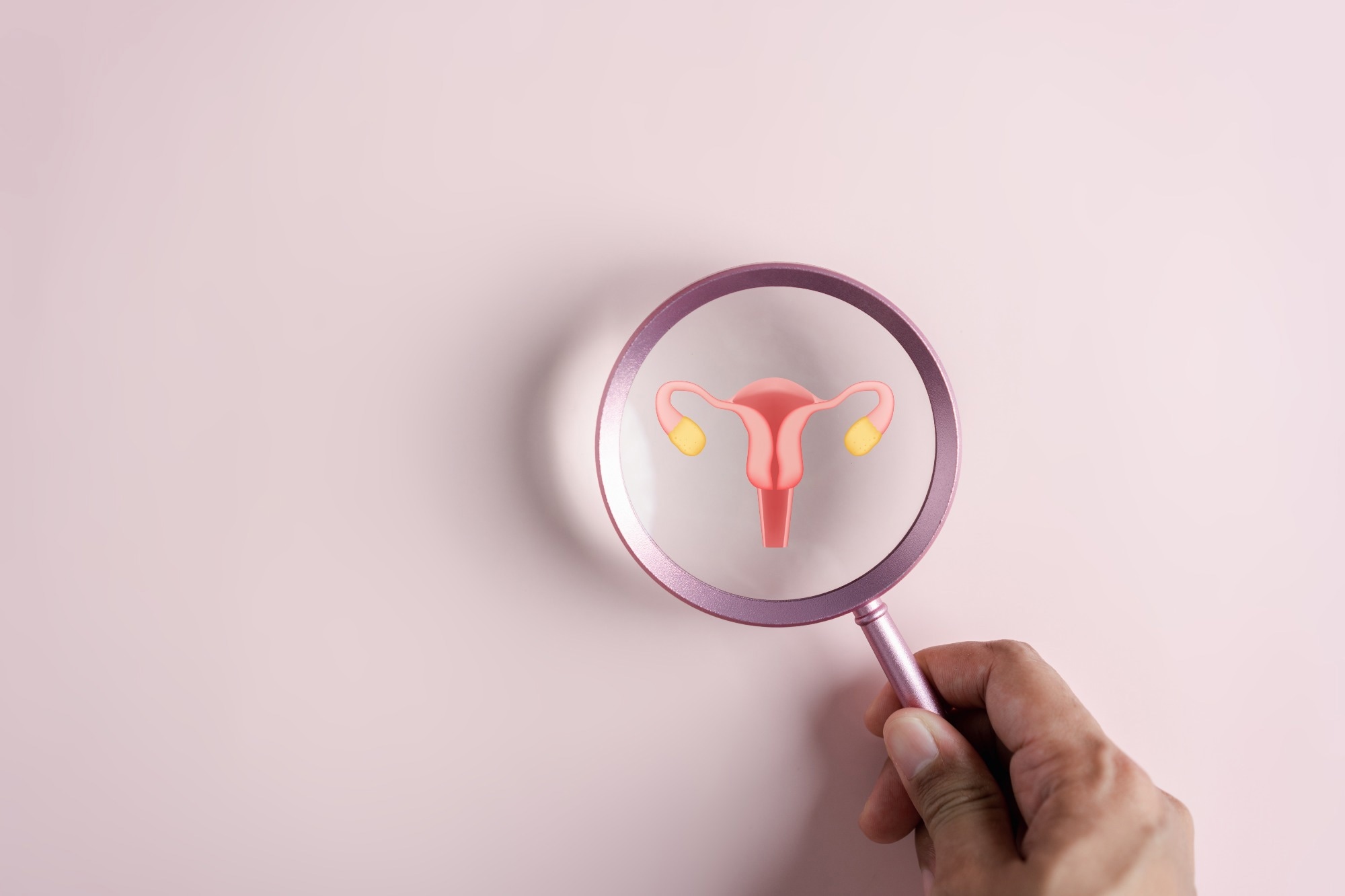 El síndrome de ovario poliquístico se asocia a un mayor riesgo de resultados adversos en el parto