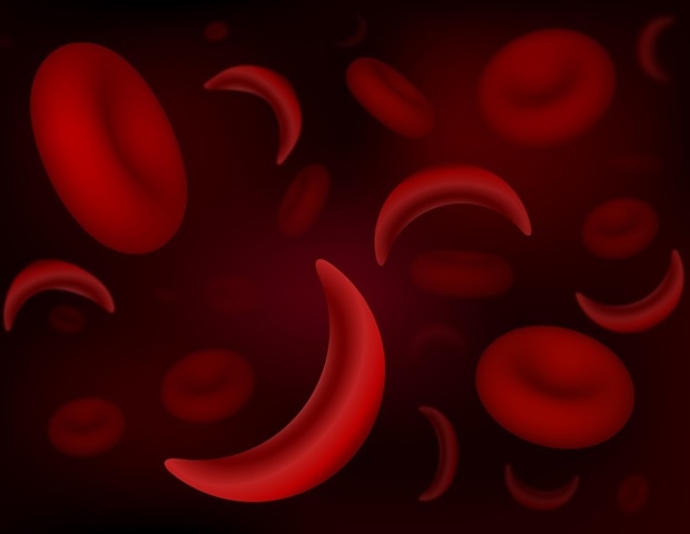 Un estudio revela que la hidroxiurea no altera la reserva ovárica en la anemia falciforme
